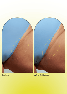 Ingrown Concentrate Oil